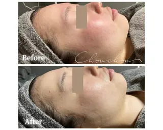 beauty & health salon Chou chou所属・ニキビ・毛穴🌿肌を 育てるララピール✨のエステ・リラクイメージ