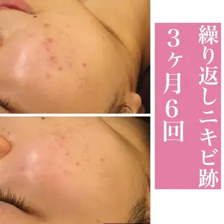 ロング カラー パーマ ヘアアレンジ メンズ キッズ ネイル マツエク・マツパ 都内で出来る肌管理！ 最短ニキビ改善のエステ・リラクイメージ