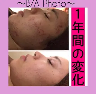 ニキビ特化型エステ 🍓最短で肌質改善のエステ・リラクイメージ