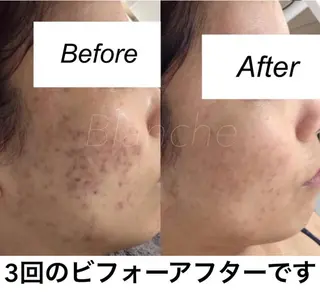 ミディアム カラー パーマ ヘアアレンジ キッズ ネイル マツエク・マツパ 都度払い肌質改善 &脱毛Blancheのエステ・リラクイメージ