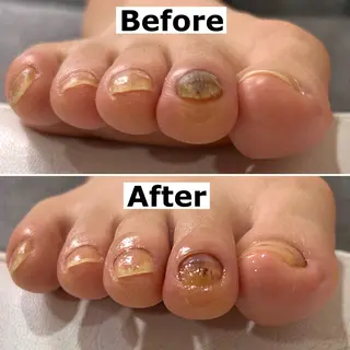 ネイル Mellow nail所属・巻爪無料モデル募集 ✨🦶MEGUMIのネイルデザイン