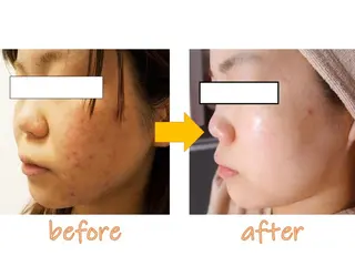 ニキビ専門サロン ド　ミモザのエステ・リラクイメージ