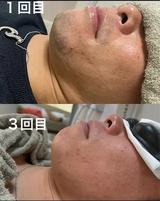 メンズ ☀️Akala☀️ メンズ脱毛のエステ・リラクイメージ