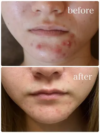 ハーブピーリング🌿 Vivaceのその他イメージ