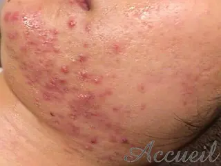 ニキビ特化型エステ 🍓最短で肌質改善のエステ・リラクイメージ