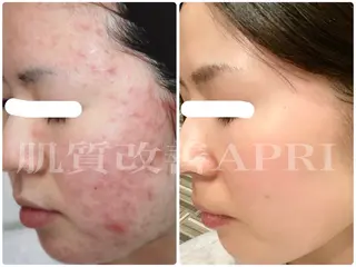パーソナル肌質改善 🦋APRI🅿️有のエステ・リラクイメージ