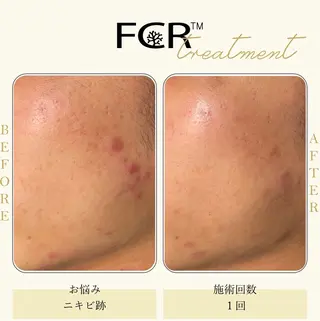 ニキビ改善シャルム ココハーブピーリングのエステ・リラクイメージ