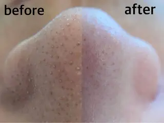 韓国式３D毛穴洗浄＆ 脱毛vive京橋のエステ・リラクイメージ