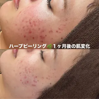 BELLIS HUIT所属・ハーブピーリング那覇 BELLISHUITのエステ・リラクイメージ