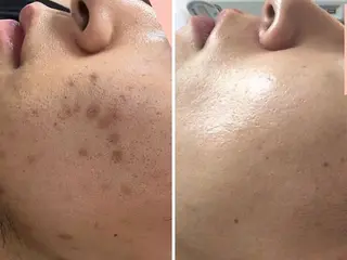 メンズ ハーブピーリング肌 管理🌿Ante関内のエステ・リラクイメージ