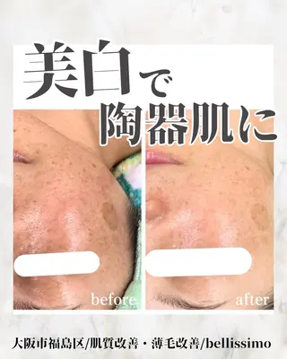 bellissimo 【ベリッシモ】所属・ちひろ　痩身/ハーブ bellissimoのエステ・リラクイメージ