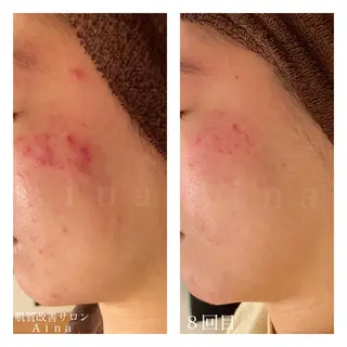 ミディアム カラー パーマ ヘアアレンジ メンズ キッズ ネイル マツエク・マツパ ニキビ跡専門サロン Ainaのエステ・リラクイメージ