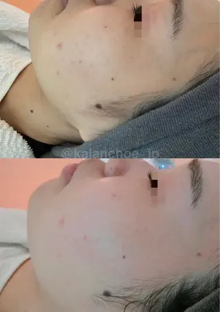 肌質改善 KALANCHOEのエステ・リラクイメージ