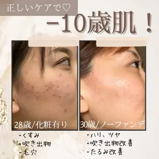 鍼灸•マッサージサロンCalfa所属・《美肌･小顔》美容鍼 ＆マッサージ＊MEIのエステ・リラクイメージ