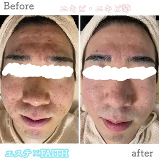 ニキビ&跡改善サロン オーナー光木のエステ・リラクイメージ