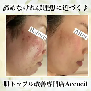 ミディアム カラー パーマ ヘアアレンジ メンズ キッズ ネイル マツエク・マツパ ニキビ・肌質改善専門 ♡人生が変わるサロンのエステ・リラクイメージ