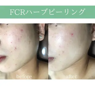 心斎橋痩身ダイエット 韓国.美容鍼.小顔のエステ・リラクイメージ