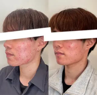 メンズ 美容鍼灸サロン　TIARA所属・鍼灸サロン TIARA　美容鍼のエステ・リラクイメージ