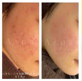 ニキビ跡専門サロン Ainaのエステ・リラクイメージ