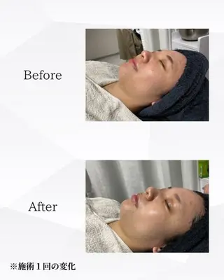 ハーブピーリング🌿 REVI/Ayanoのエステ・リラクイメージ