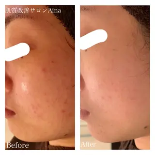 ミディアム パーマ キッズ ネイル マツエク・マツパ ニキビ跡専門サロン Ａｉｎａのエステ・リラクイメージ