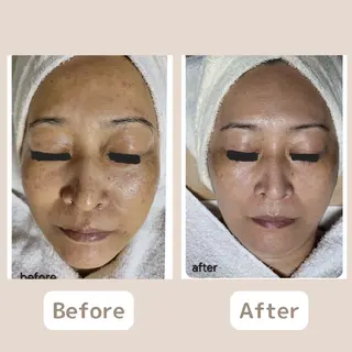 レチノール/ニキビ/ 毛穴ケア　浅川のエステ・リラクイメージ