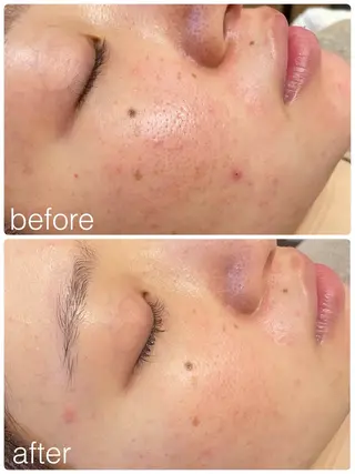 Belsia千歳烏山 ピーリング＆眉毛のエステ・リラクイメージ