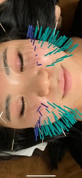 表参道鍼灸院K 美容鍼🔮ララピールのエステ・リラクイメージ