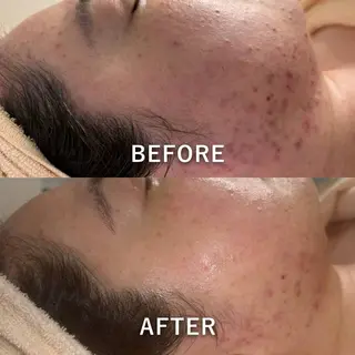 【ハーブピーリング】 Allumentのエステ・リラクイメージ