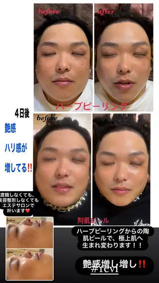 ハーブピーリング/韓国肌管理/フェイシャル/毛穴洗浄/眉毛/顔脱毛【糸脱毛専門】rev所属・ハーブピーリング🌹 毛穴洗浄❤️眉waxのエステ・リラクイメージ