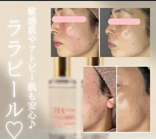 メンズ 毛穴，ニキビ跡 改善総合サロンのエステ・リラクイメージ