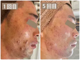 Sha.Lu.Lu.所属・本気の肌質改善/ ハーブピーリングのエステ・リラクイメージ