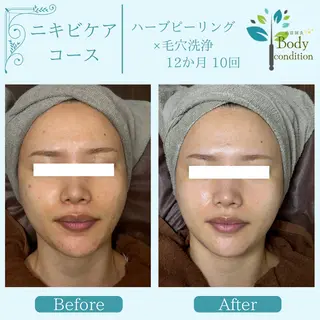 小顔ハーブピーリング 美容鍼/毛穴洗浄のエステ・リラクイメージ