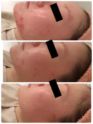 美肌脱毛・ハーブピーリング専門店Larin la beaute所属・Larin la beauteのエステ・リラクイメージ