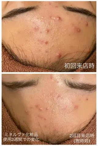 夏までに肌荒れ卒業 するサロン🌻のエステ・リラクイメージ