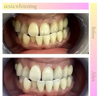 ecxia white 高田馬場所属・セルフホワイトニング エクシア 高田馬場のその他イメージ