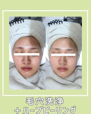 |ピーリング・毛穴| soina神楽坂のエステ・リラクイメージ