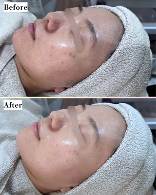 |ピーリング・毛穴| soina神楽坂のエステ・リラクイメージ