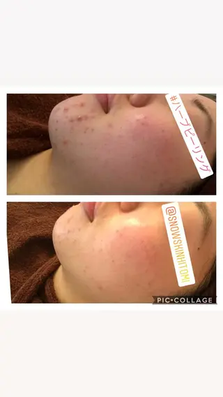 ニキビ/肌質改善専門 Snow skinのエステ・リラクイメージ