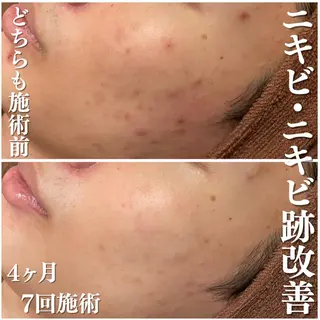 都内で出来る肌管理！ 最短ニキビ改善のエステ・リラクイメージ