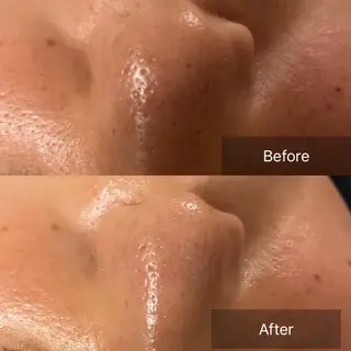 美楽鍼 びらくしんのその他イメージ