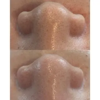 himee所属・艶肌ハーブピーリング /毛穴洗浄のエステ・リラクイメージ