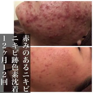 ミディアム カラー パーマ ヘアアレンジ メンズ キッズ ネイル マツエク・マツパ ニキビ・肌質改善専門 ♡人生が変わるサロンのエステ・リラクイメージ