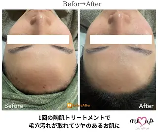 Meupニキビ専門店 背中/ハーブ/肌管理のその他イメージ