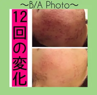 夏までに肌荒れ卒業 するサロン🌻のエステ・リラクイメージ