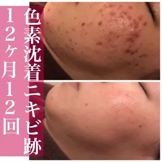 セミロング カラー パーマ ヘアアレンジ メンズ キッズ ネイル マツエク・マツパ アイブロウ ニキビ特化型エステ 🍓最短で肌質改善のエステ・リラクイメージ