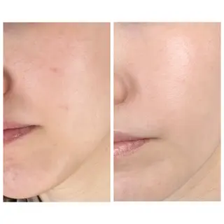 ニキビ/敏感肌/乾燥 Lilyauraのエステ・リラクイメージ