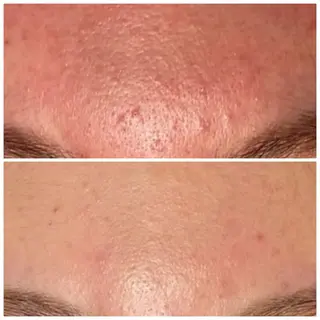 ハーブピーリング re:proのエステ・リラクイメージ