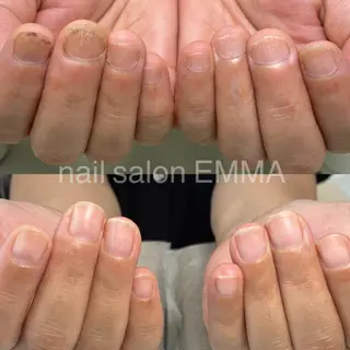 ネイル 広島市南区(広島県) /深爪/自爪育成のネイルデザイン