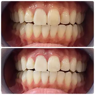 White Berry SELF BEAUTY SALON所属・セルフホワイトニング 🦷口元垢抜け✨のその他イメージ